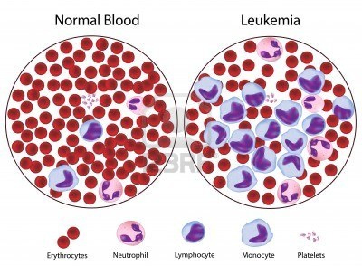 Leukemia | By Premita Oli1200 x 882